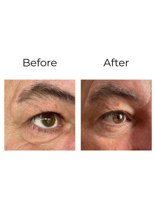 Anti-wrinkle eye contour cream “shock action effect” with LIPHASYN™ 20 ml Anti-wrinkle eye contour cream “shock action effect” with LIPHASYN™ 20 ml
